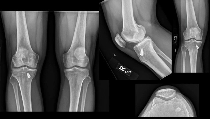X-ray images of a knee joint from different angles